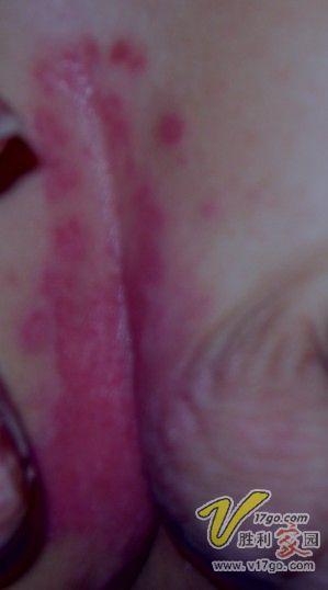 宝宝这是长了什么疹呀?急