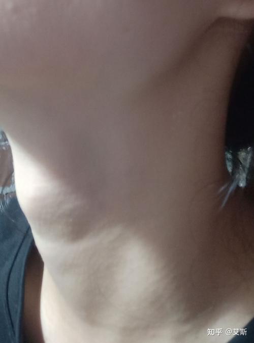 女生有喉结怎么办