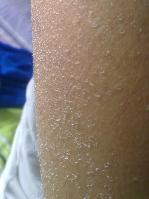 搓澡后就这样起白色的皮屑