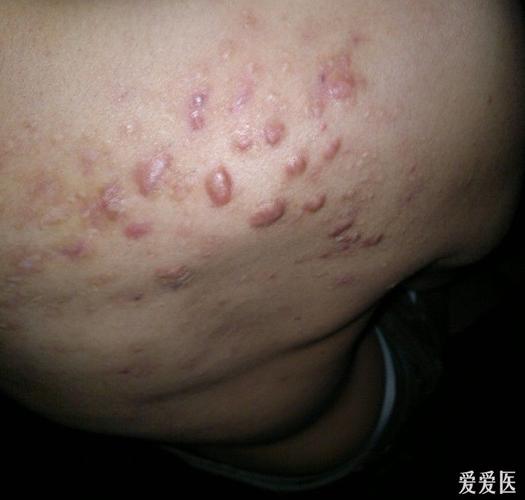 看图识病———瘢痕疙瘩