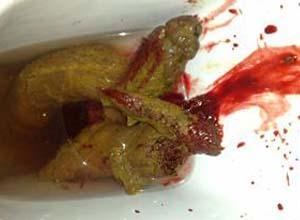 常见于肠出血和肠癌.