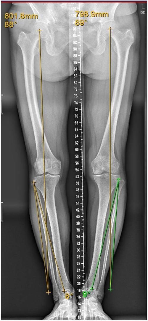 【专家访谈】保护膝关节 且行且珍"膝"——膝骨性关节