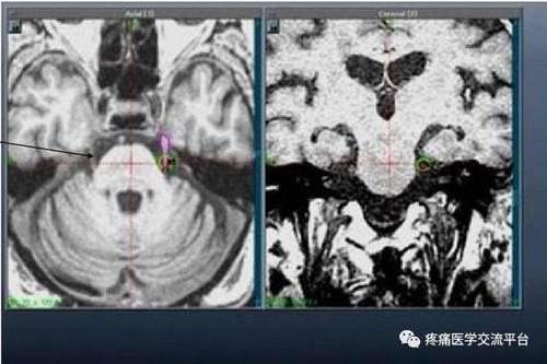 三叉神经解剖及mr表现