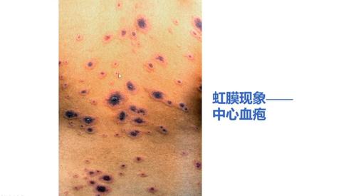 其它 多形红斑 写美篇 多形红斑,又称多形渗出性红斑,是一种病因较