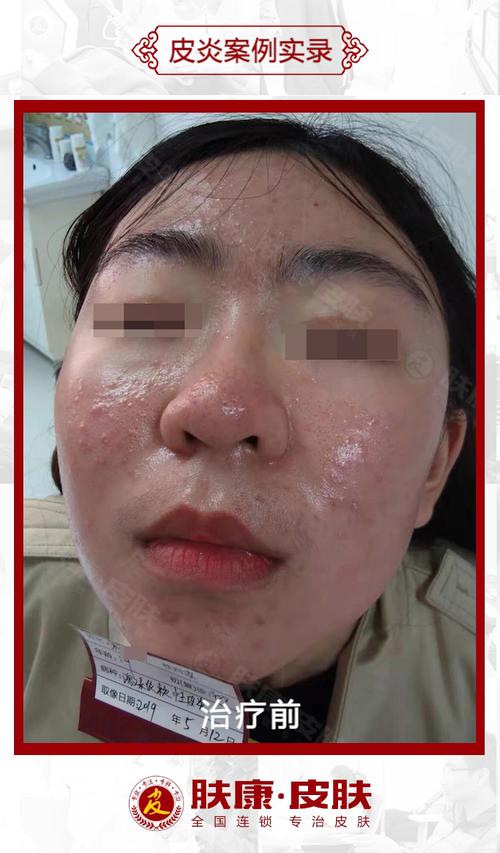 面部激素皮炎的原因以及治疗?_皮炎_激素脸_皮肤炎症