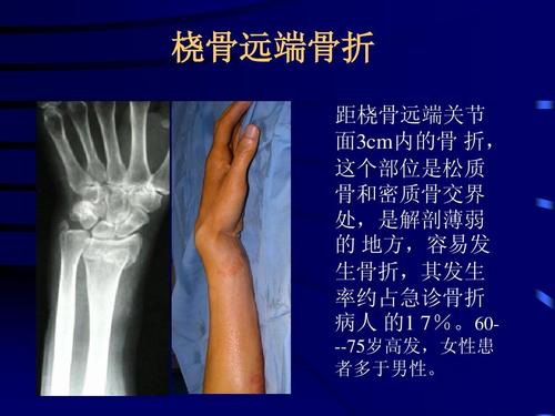 桡骨远端骨折治疗