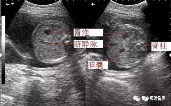 7,胎儿腹围测量标准切面:3.