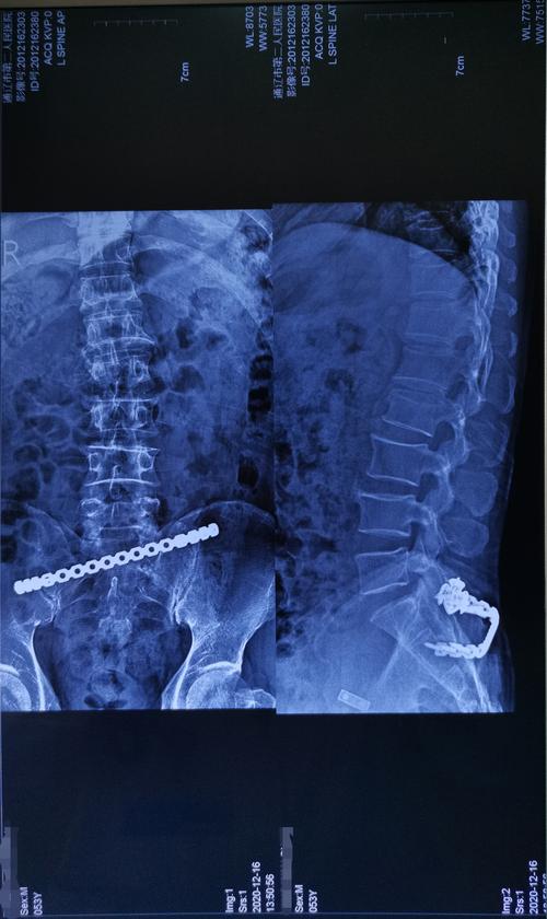 54岁腰椎压缩性骨折切开复位椎弓根内固定手术一例