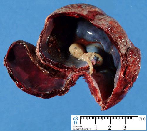 八周胎在胎盘内的样子