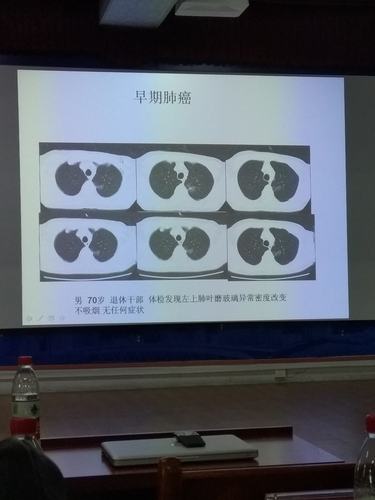 早期肺癌的影像诊断