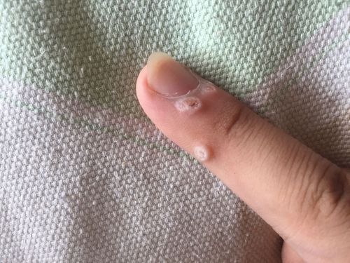 手指长有几处类似于茧疙瘩,请问大家这属于什么皮肤病