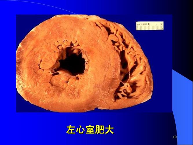 左心室肥大 10