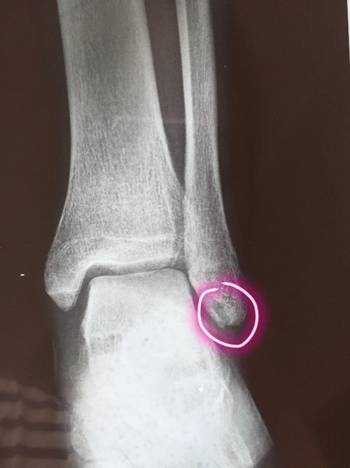 左外踝腓骨下端骨折