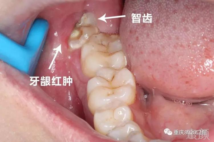 智齿一定要拔吗?拔不拔牙要看牙片!