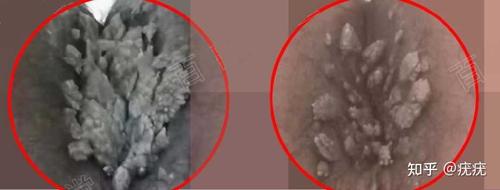 得了肛门尖锐湿疣会传染其他人吗