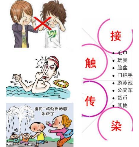 红眼病真的看一眼就会被传染吗