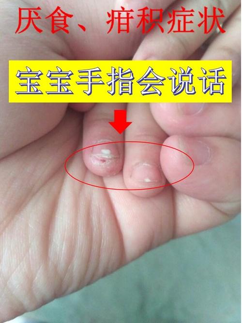 还在为宝宝挑食厌食的毛病,疳积而烦恼的家长们,赶紧像我这样给孩子