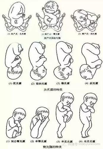 了解胎位不正为分娩做好准备