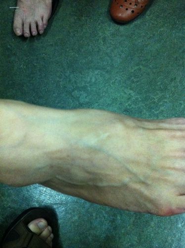 脚背上隆起的肿物就是腱鞘囊肿