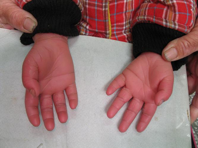 进行性对称性红斑角化症