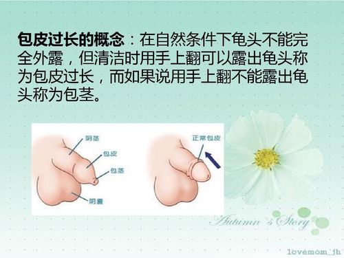 男性包皮环切手术及护理