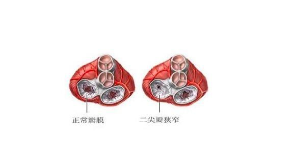 瓣膜病二尖瓣狭窄