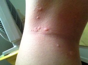 孩子被螨虫感染有什么症状 如果孩子感染了螨虫,一般在夜间面部会有