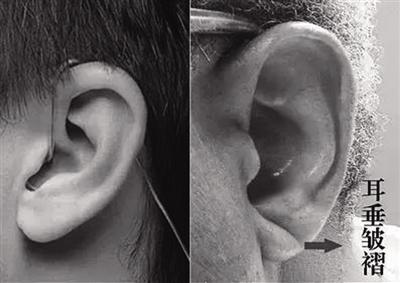 从耳垂皱褶能提前预知冠心病?