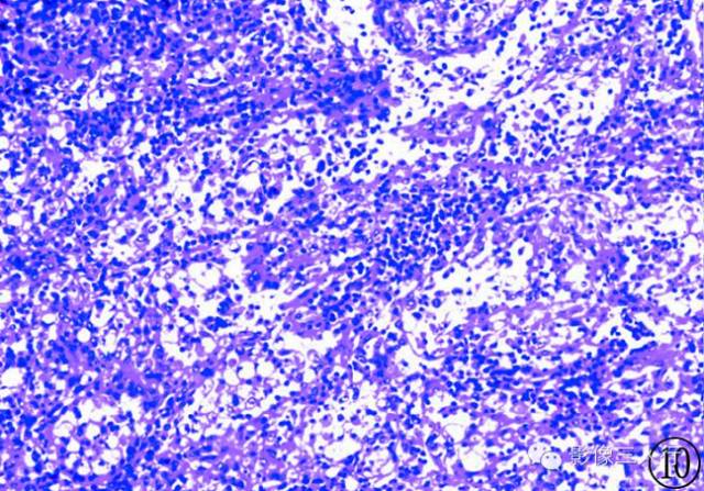 脾脏窦岸细胞血管瘤ct和mri表现与病理对照