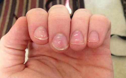指甲上出现了小白点 警惕是生了这种病