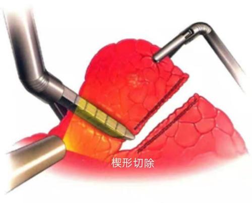 肺部常见手术方式楔形切除肺段切除肺叶切除