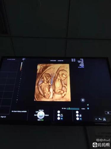 13周nt时候照片,异卵双羊双绒双胞胎