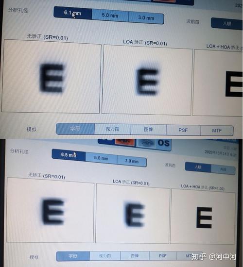 近视手术术后重影眩光对于蔡司i技术配镜的个人体验.