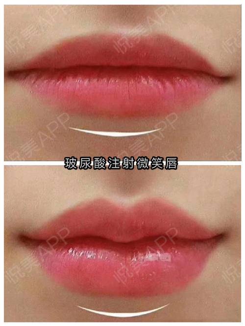微笑唇和嘟嘟唇到底有什么区别?