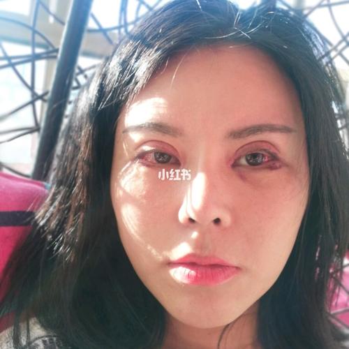 刚刚拆完线,疼的是眼泪直流,本来想让医生帮我把眼里的泡扎破的,医生