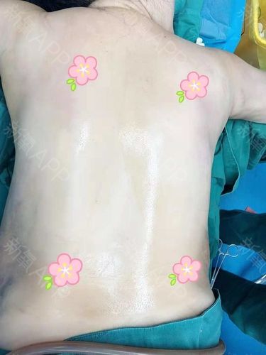 吸脂瘦背部好不好_效果图_孔雀lida吸脂瘦背部术后第1