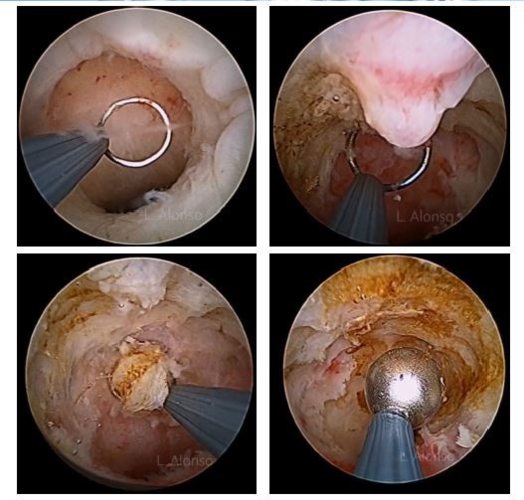 【镜·界】宫腔镜和腹腔镜下的剖宫产瘢痕憩室修复术