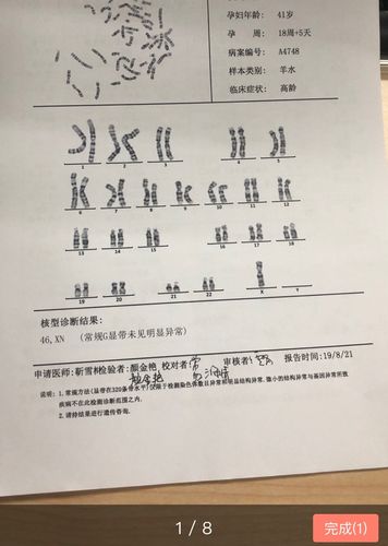 羊水穿刺芯片结果显示可能存在21三体,核型结果显示正常.