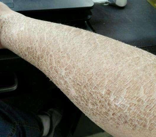 小腿鱼鳞皮肤怎么办