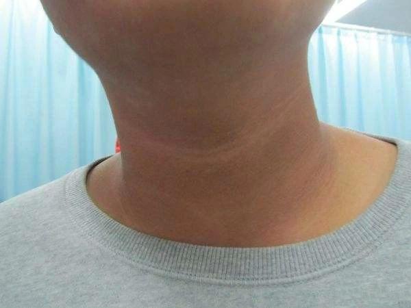 如果得肺癌,脖子先发黑!很多人以为是没洗净