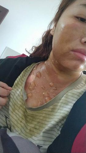 请问以下图片是几度烫伤