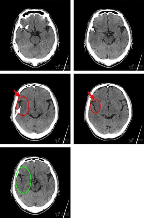 6 个病例学会"脑梗死"的 4大ct 征象