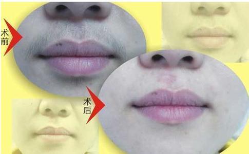【服务项目】【激光脱毛】公立医院医师,一年脱唇毛,干净利落
