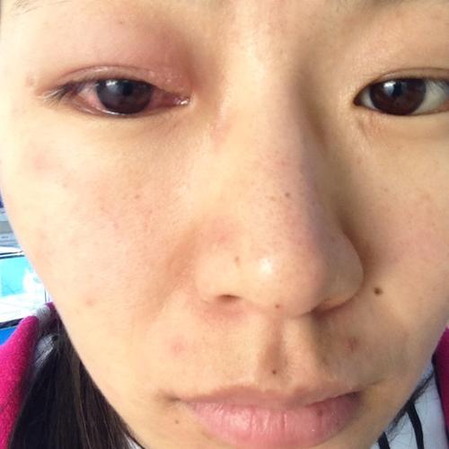 眼睛肿了,感觉像是火疖子,眼睛