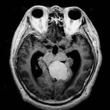 小脑脑桥角脑膜瘤的手术处理困难,因为有众多重要神经血管缠绕,所以术