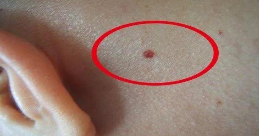 2岁男童身上红点变紫点被查出白血病什么情况