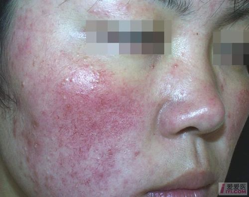 面部皮疹2年如图请会诊谢谢