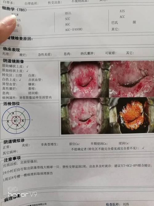 请问这是宫颈糜烂几度