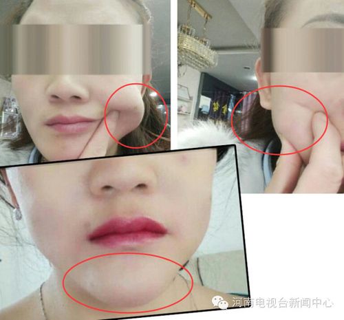 济源的刘女士自从打了一次玻尿酸以后,脸就变成这样了!