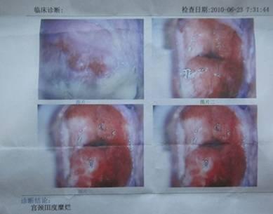 青岛重度宫颈糜烂该怎么治疗哪家医院治得好